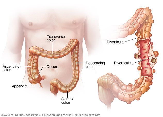 What is Diverticular disease? What can I eat? Image